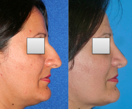 Rhinoplastie Lyon Mojallal