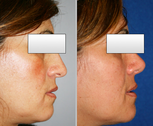 Rhinoplastie Lyon Mojallal