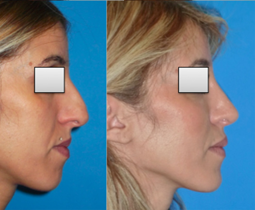 Rhinoplastie Lyon Mojallal