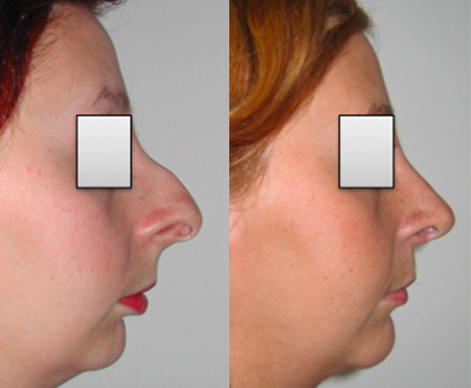 Rhinoplastie Lyon Mojallal