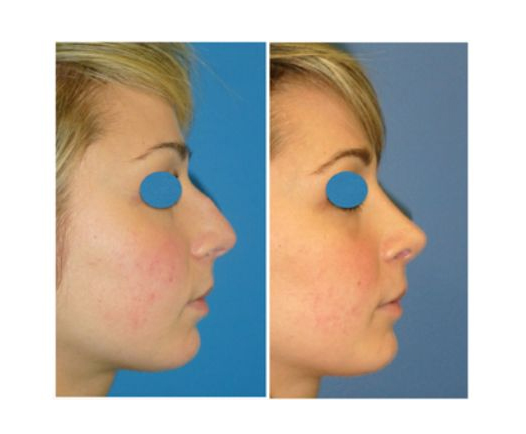 Rhinoplastie Lyon Mojallal