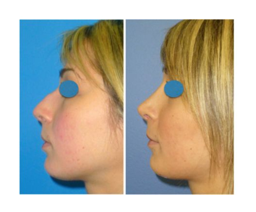 Rhinoplastie Lyon Mojallal